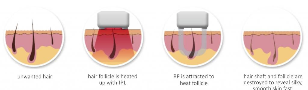 follicle